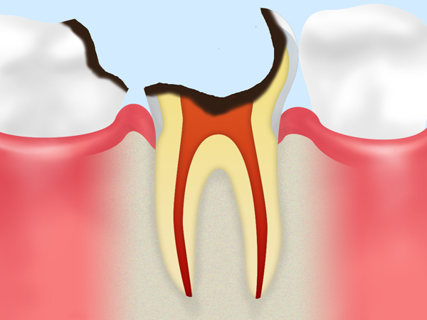 歯根の先に達した虫歯