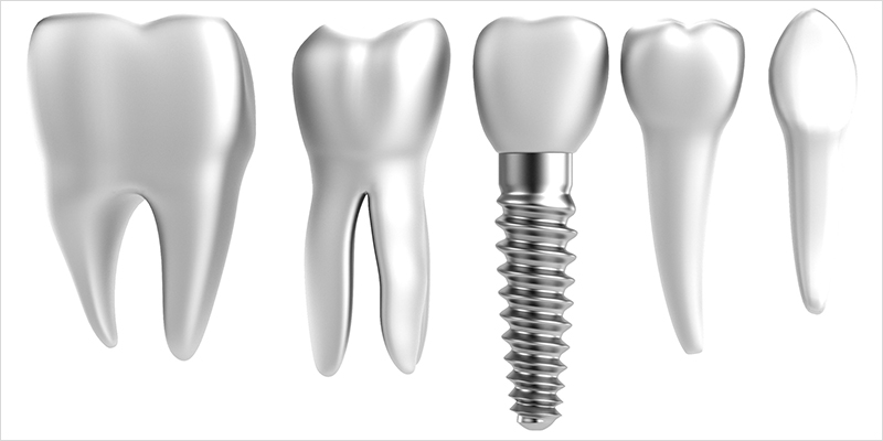失った歯を補うためのひとつの選択肢～インプラント治療～