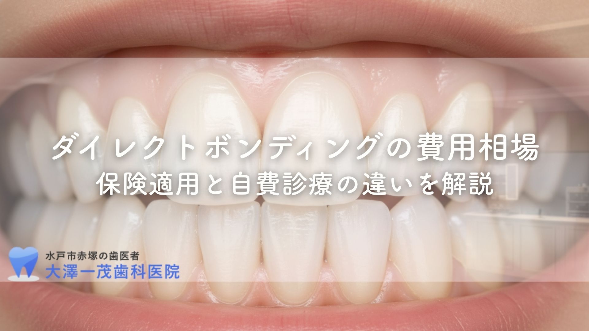 ダイレクトボンディングの費用相場〜保険適用と自費診療の違いを解説